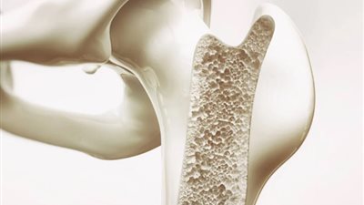 تسوس العظام.. أعراض خطيرة ومضاعفات قاتلة