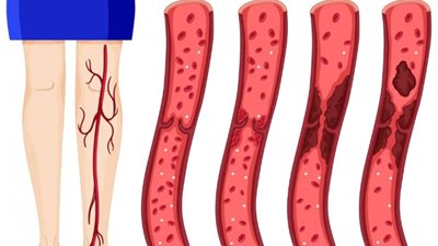 دوالي الساقين.. مضاعفات خطيرة لمشكلة شائعة
