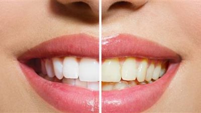 لابتسامة ناصعة.. طرق منزلية لتبييض الأسنان بالأعشاب الطبيعية