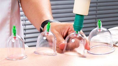 العلاج بالحجامة.. ما بين العلم والطب والدين